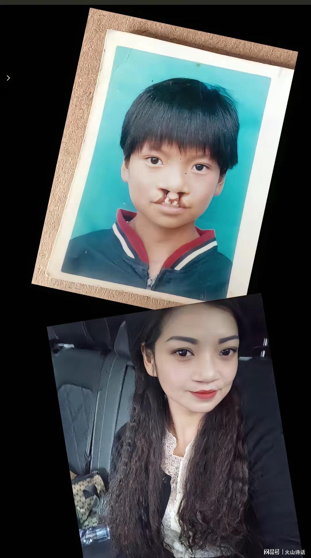 澳洲幸运10-震惊！为声援李亚鹏，一漂亮女孩坦然展示自己唇腭裂手术前后照片